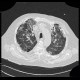 Pneumocystis carinii, HRCT: CT - Computed tomography