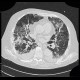 Pneumocystis carinii, HRCT: CT - Computed tomography