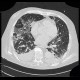 Pneumocystis carinii, HRCT: CT - Computed tomography