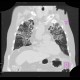 Pneumocystis carinii, HRCT: CT - Computed tomography