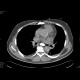 Pneumomediastinum: CT - Computed tomography