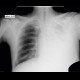 Pneumonia: X-ray - Plain radiograph
