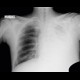 Pneumonia, lobar pneumonia: X-ray - Plain radiograph