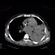 Pneumonia: CT - Computed tomography