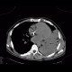 Pneumonia: CT - Computed tomography