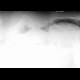 Pneumoperitoneum, lateral radiograph: X-ray - Plain radiograph