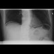 Pneumoperitoneum: X-ray - Plain radiograph