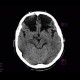 Postischemic changes in frontal lobes: CT - Computed tomography