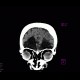 Postischemic changes in frontal lobes: CT - Computed tomography