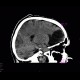 Postischemic changes in frontal lobes: CT - Computed tomography