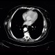 Metastasis of malignant melanoma into skin: CT - Computed tomography