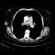 Metastasis of malignant melanoma into skin: CT - Computed tomography