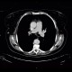 Metastasis of malignant melanoma into skin: CT - Computed tomography