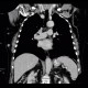Metastasis of malignant melanoma into skin: CT - Computed tomography