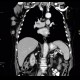 Metastasis of malignant melanoma into skin: CT - Computed tomography