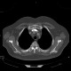 Osteopoikilosis, systemic bone disorder: CT - Computed tomography