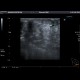 Lymphedema and seroma of the breast, postoperatively: US - Ultrasound