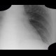 Pneumopericardium, postoperative: X-ray - Plain radiograph