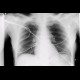 Pneumoperitoneum, postoperatively on supine chest radiograph: X-ray - Plain radiograph