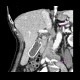 Porcelain gall bladder: CT - Computed tomography