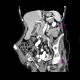 Porcelain gall bladder: CT - Computed tomography