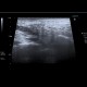 Postirradiation changes of submandibular region and lymph nodes: US - Ultrasound