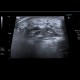 Postirradiation changes of submandibular region and lymph nodes: US - Ultrasound