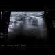 Postirradiation changes of submandibular region and lymph nodes: US - Ultrasound
