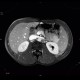 Postinflammatory changes of the tail of pancreas: MRI - Magnetic Resonance Imaging