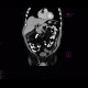 Preperitoneal lipoma: CT - Computed tomography