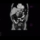 Preperitoneal lipoma: CT - Computed tomography