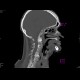 Transverse fracture of the dens axis: CT - Computed tomography