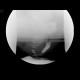 Rectal prolapse: RF - Fluoroscopy