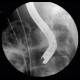 ERCP, migration of duodenobiliary drain: RF - Fluoroscopy