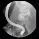 ERCP, migration of duodenobiliary drain: RF - Fluoroscopy