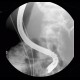 ERCP, migration of duodenobiliary drain: RF - Fluoroscopy