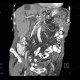 Malposition and migration of duodenobiliary stent, before removal: CT - Computed tomography