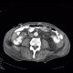 Malposition and migration of duodenobiliary stent, before removal: CT - Computed tomography