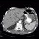 Malposition and migration of duodenobiliary stent, before removal: CT - Computed tomography