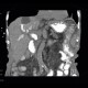 Malposition and migration of duodenobiliary stent, after removal: CT - Computed tomography
