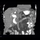 Malposition and migration of duodenobiliary stent, after removal: CT - Computed tomography