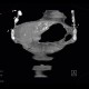Malposition and migration of duodenobiliary stent, after removal: CT - Computed tomography