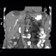 Malposition and migration of duodenobiliary stent, after removal: CT - Computed tomography