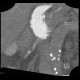 Malposition and migration of duodenobiliary stent, after removal: CT - Computed tomography