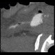 Malposition and migration of duodenobiliary stent, after removal: CT - Computed tomography