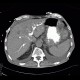 Malposition and migration of duodenobiliary stent, after removal: CT - Computed tomography
