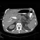 Malposition and migration of duodenobiliary stent, after removal: CT - Computed tomography