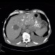Malposition and migration of duodenobiliary stent, after removal: CT - Computed tomography