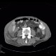 Malposition and migration of duodenobiliary stent, after removal: CT - Computed tomography