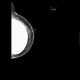 Breast implants, mammography: MMG - Mammography